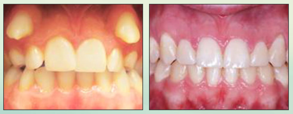 Chad Johnson Orthodontic Before and After Photo_10