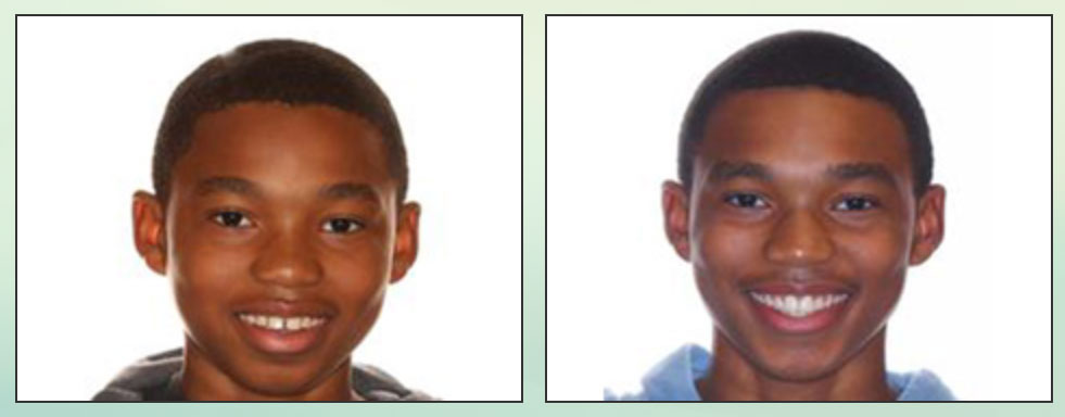 Chad Johnson Orthodontic Before and After Photo_12