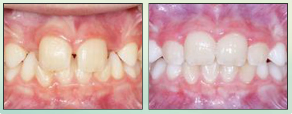 Chad Johnson Orthodontic Before and After Photo_2