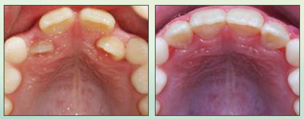Chad Johnson Orthodontic Before and After Photo_3