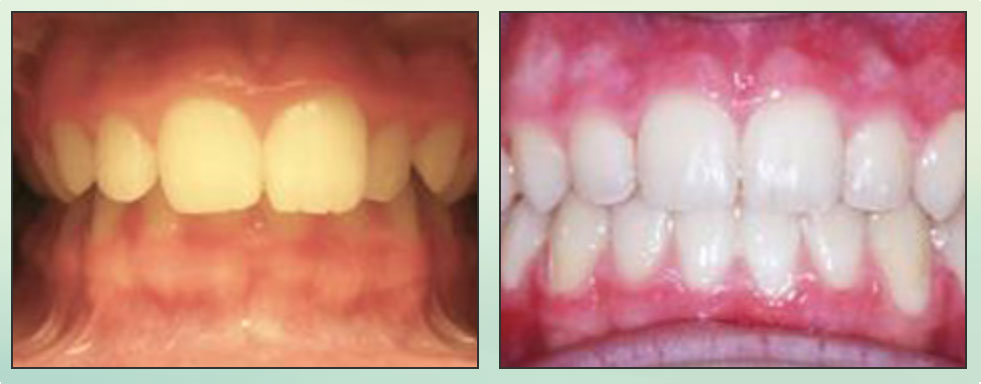 Chad Johnson Orthodontic Before and After Photo_4