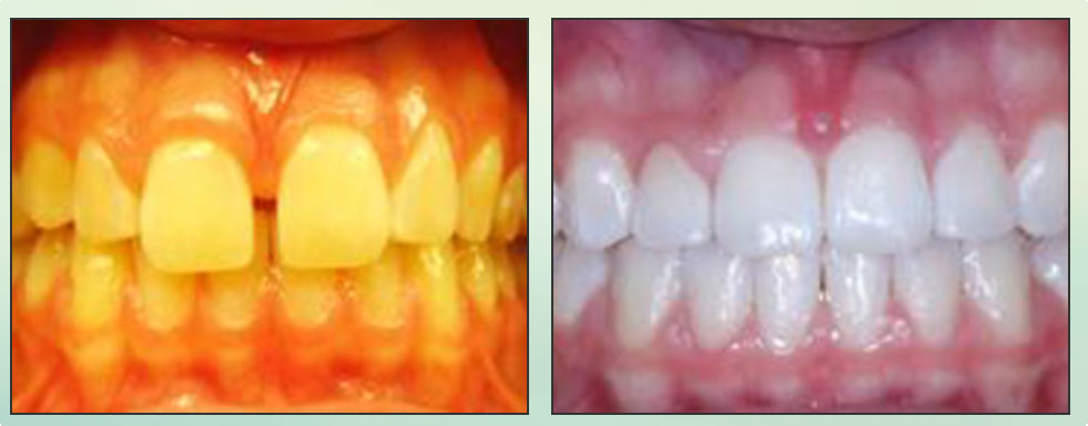 Chad Johnson Orthodontic Before and After Photo_6