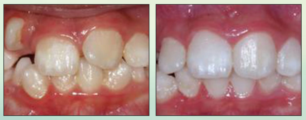 Chad Johnson Orthodontic Before and After Photo_8