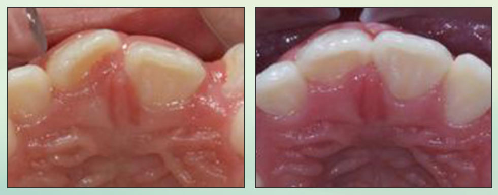Chad Johnson Orthodontic Before and After Photo_9