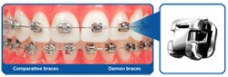 Chad Johnson Orthodontics The Damon Smile System