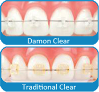 Chad Johnson Orthodontics The Damon Clear System