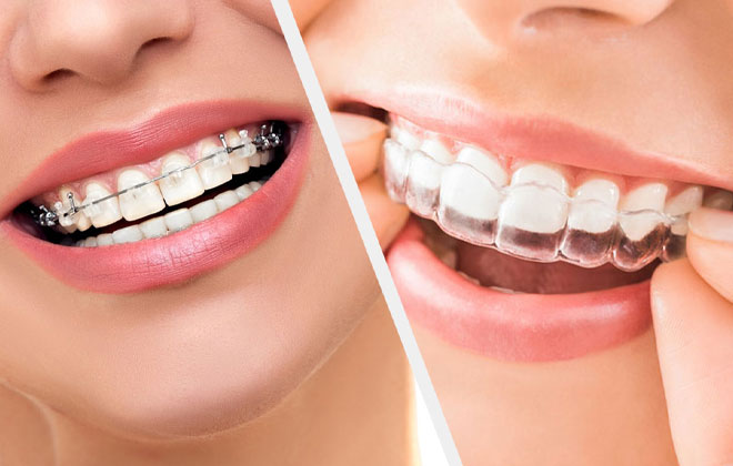 Can Anyone Get Clear Braces? - Metro Smiles Dental Forest Hills New York